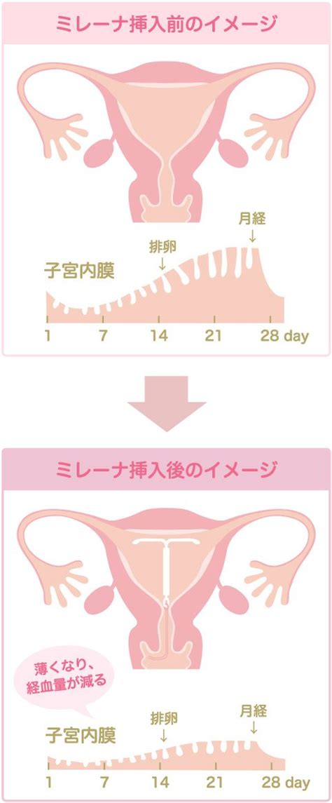 ミレーナ 中出し|「ミレーナの避妊について」に関する医師の回答